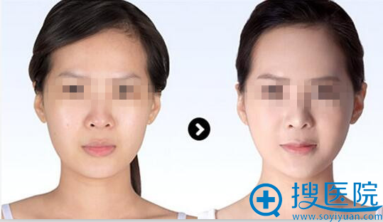 达拉斯综合美鼻案例图2 达拉斯综合美鼻案例图2
