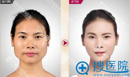 广州华美面部脂肪填充案例图 广州华美面部脂肪填充案例图