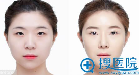 广州华美双眼皮前后对比效果图 广州华美双眼皮前后对比效果图