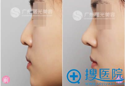 广州曙光整形医院假体隆鼻案例图 广州曙光整形医院假体隆鼻案例图