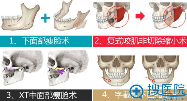张笑天XT4S改脸型4大特色技术 张笑天XT4S改脸型4大特色技术