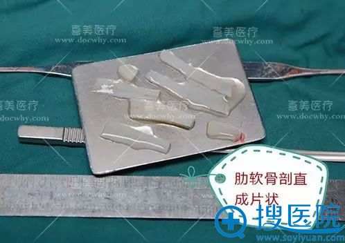 将取出的肋软骨剖直变薄,充分浸泡变形后再雕刻 将取出的肋软骨剖直变薄,充分浸泡变形后再雕刻