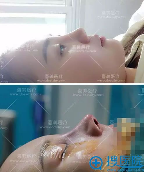 术后即刻对比效果 术后即刻对比效果