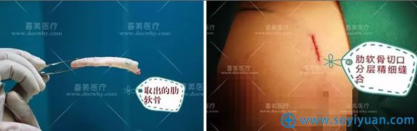 取第6肋软骨后精细缝合伤口 取第6肋软骨后精细缝合伤口