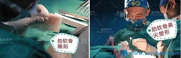将肋软骨雕刻后进行鼻尖塑形 将肋软骨雕刻后进行鼻尖塑形