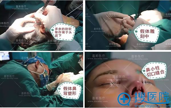 鼻背鼻尖整体塑形完成缝合 鼻背鼻尖整体塑形完成缝合