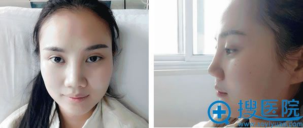 求美者鼻综合修复术前照 求美者鼻综合修复术前照