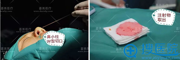 取出求美者鼻部不明注射物 取出求美者鼻部不明注射物