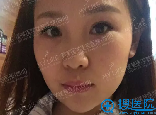 真实案例告诉你成都美莱韩国栋隆鼻怎么样 鼻综合6600元起