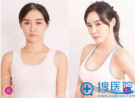 假体丰胸前后对比照 假体丰胸前后对比照