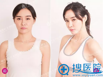 隆胸术前术后对比照 隆胸术前术后对比照