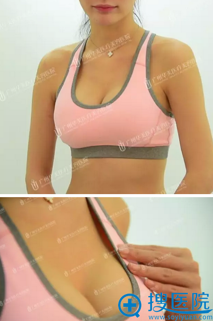 假体隆胸术后写真 假体隆胸术后写真