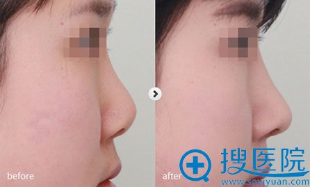 温州星范硅胶假体隆鼻案例图 温州星范硅胶假体隆鼻案例图