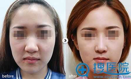 温州星范自体软骨隆鼻案例图 温州星范自体软骨隆鼻案例图