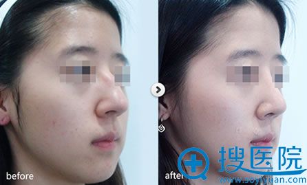 温州星范膨体隆鼻案例图 温州星范膨体隆鼻案例图