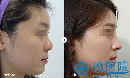 温州星范注射隆鼻案例效果图 温州星范注射隆鼻案例效果图