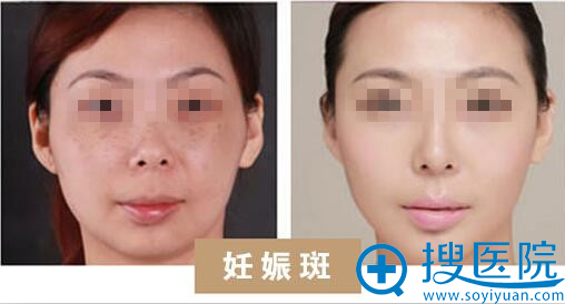 妊娠斑 妊娠斑