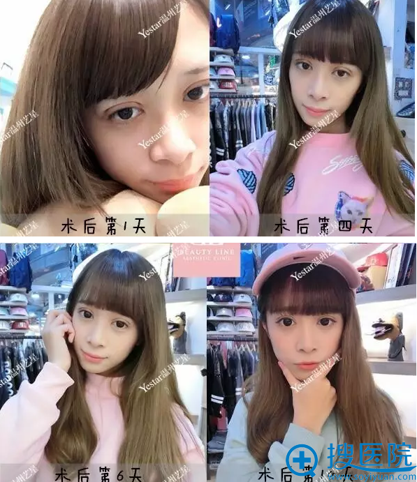 割双眼皮术后第1天到第10天恢复效果 割双眼皮术后第1天到第10天恢复效果
