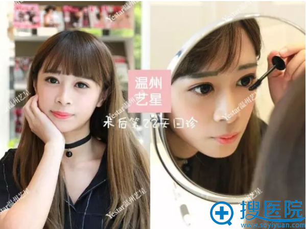 艺星双眼皮术后22天复诊的效果 艺星双眼皮术后22天复诊的效果