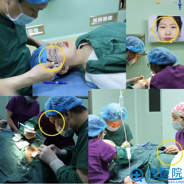 王阔院长切开双眼皮全过程 王阔院长切开双眼皮全过程