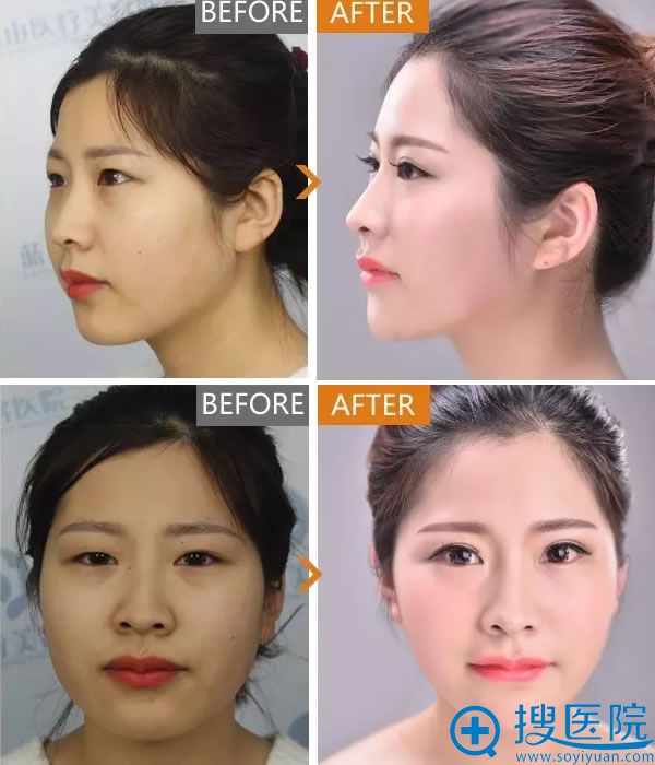 双眼皮、隆鼻、瘦脸后对比照片 双眼皮、隆鼻、瘦脸后对比照片