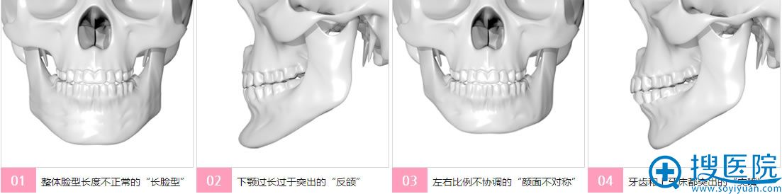 韩国那木整形医院双颚整形真实案例 告诉你明星变美的秘密