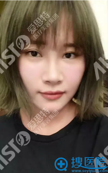 鼻修复术后效果,感谢爱思特 鼻修复术后效果,感谢爱思特