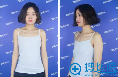 从A升到C辣妈真实隆胸对比案例告诉你林沸腾隆胸技术怎么样