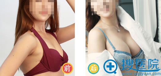 金宝玉假体隆胸代表案例 金宝玉假体隆胸代表案例