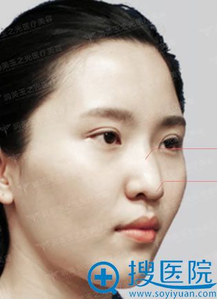 在北京玉之光做鼻综合术前照 在北京玉之光做鼻综合术前照