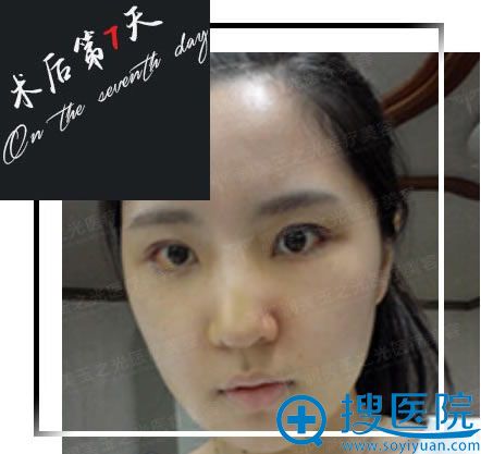 做鼻综合+自体脂肪面部填充术后第7天 做鼻综合+自体脂肪面部填充术后第7天