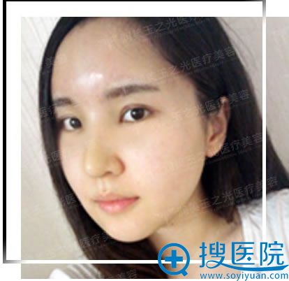 鼻综合+自体脂肪面部填充术后15天 鼻综合+自体脂肪面部填充术后15天