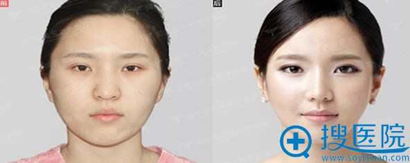 北京玉之光<!--<i data=20240710 data-id=16581></i>-->鼻综合案例图 北京玉之光<!--<i data=20240710 data-id=16581></i>-->鼻综合案例图