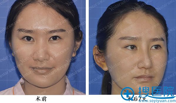 【真人案例】昆明艺星假体隆鼻加自软骨鼻尖术后恢复对比照