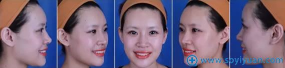 北京丽都招募免费隆鼻拍照要求 北京丽都招募免费隆鼻拍照要求