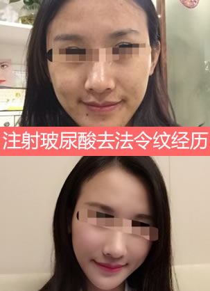 广州广大整形医院陈美运注射玻尿酸案例 填充苹果肌和法令纹