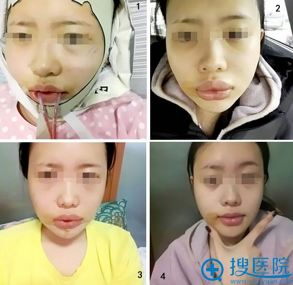 术后即刻到术后15天的恢复效果 术后即刻到术后15天的恢复效果