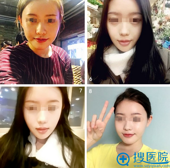术后30天到术后75天的恢复情况 术后30天到术后75天的恢复情况