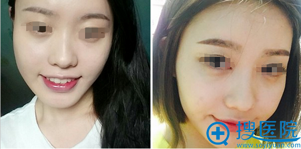 术前术后3个月对比照片 术前术后3个月对比照片