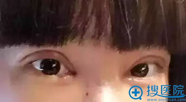 双眼皮手术后为什么会出现肉条 双眼皮手术后为什么会出现肉条