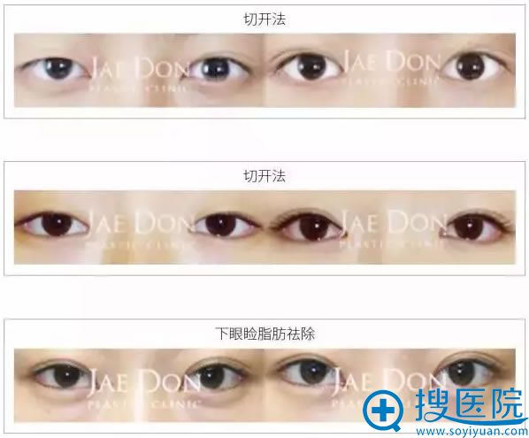 徐在敦眼部整形代表案例 徐在敦眼部整形代表案例