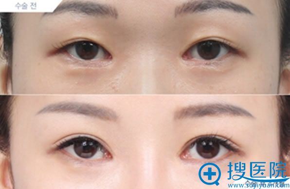 徐在敦双眼皮失败修复案例 徐在敦双眼皮失败修复案例