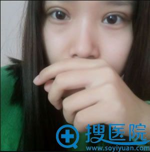 做双眼皮半个月恢复效果 做双眼皮半个月恢复效果