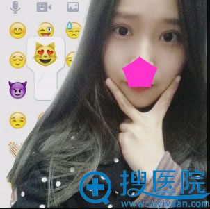 在<!--<i data=20240710 data-id=11413></i>-->做双眼皮术后恢复照 在<!--<i data=20240710 data-id=11413></i>-->做双眼皮术后恢复照