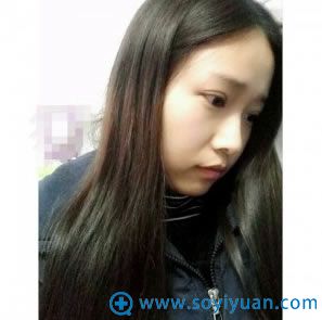 <!--<i data=20240710 data-id=11413></i>-->双眼皮一个月恢复效果图 <!--<i data=20240710 data-id=11413></i>-->双眼皮一个月恢复效果图
