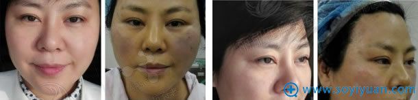 北京丽都面部线雕前后效果对比 北京丽都面部线雕前后效果对比