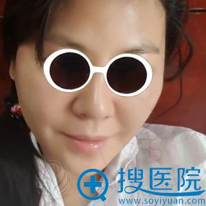 北京丽都面部线雕手术第1天 北京丽都面部线雕手术第1天