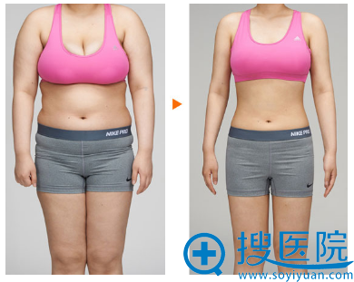 上海美莱吸脂前后对比案例 上海美莱吸脂前后对比案例