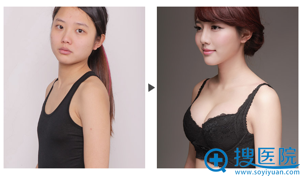 上海美莱隆胸对比案例 上海美莱隆胸对比案例