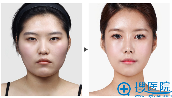 上海美莱张怀军双眼皮案例 上海美莱张怀军双眼皮案例